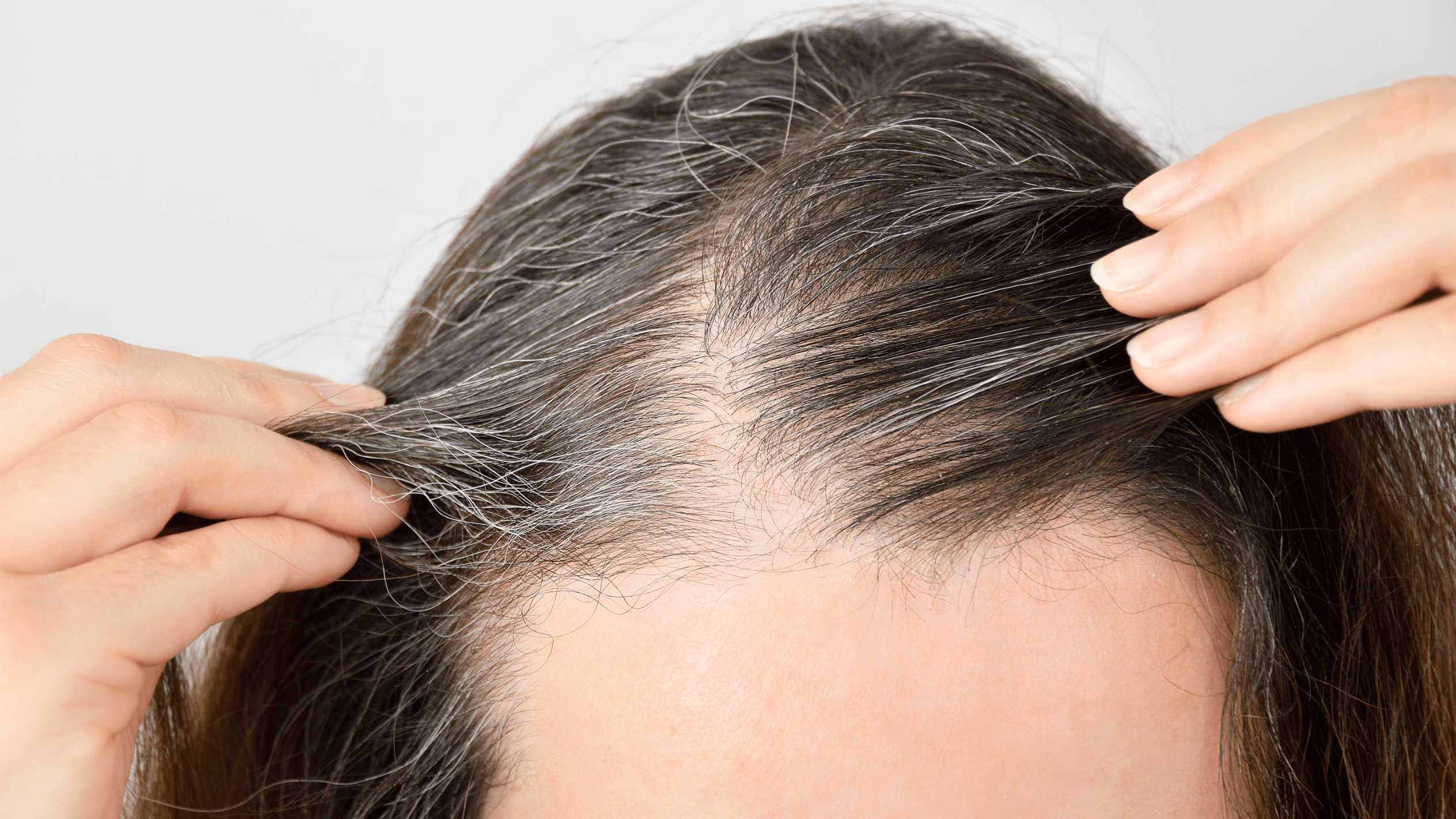 Is a NeoGraft Hair Transplant Suitable for Women?