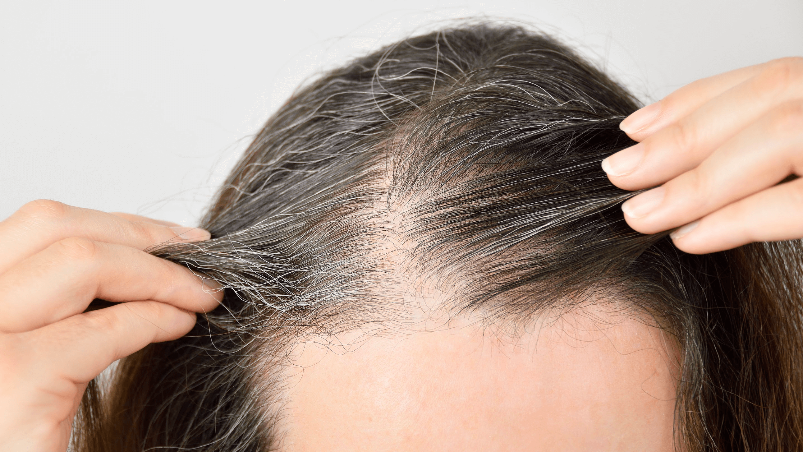 Can My Hairline Be Restored with NeoGraft® FUE Hair Restoration?
